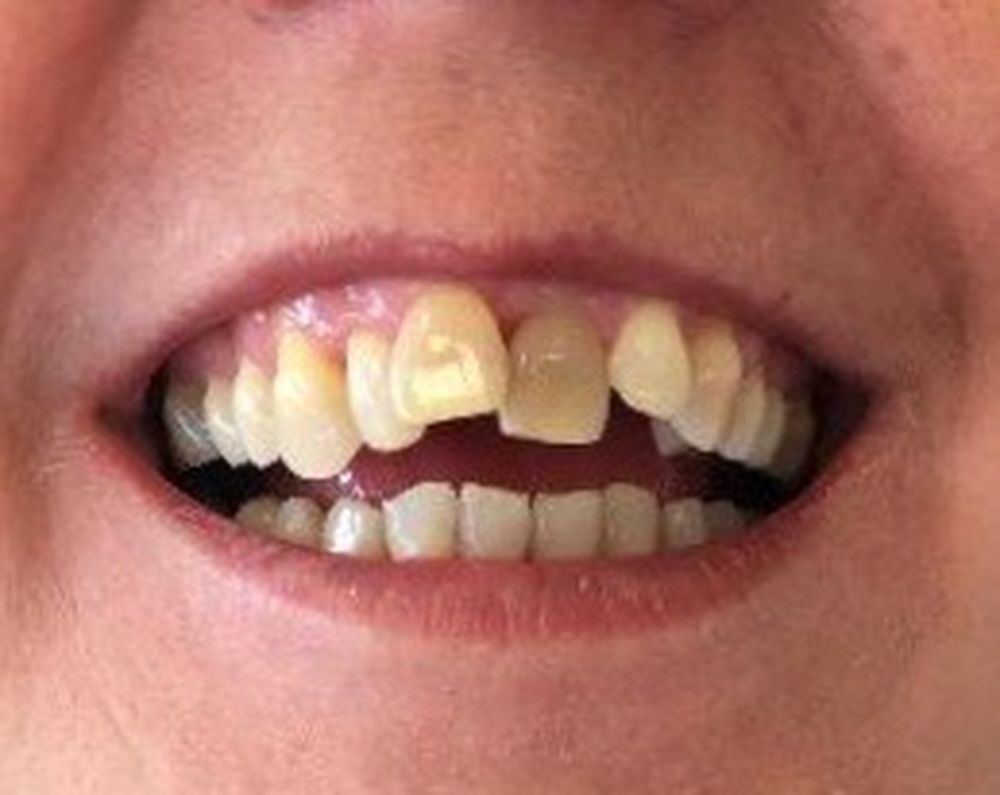 fidelma-6-month-braces-before